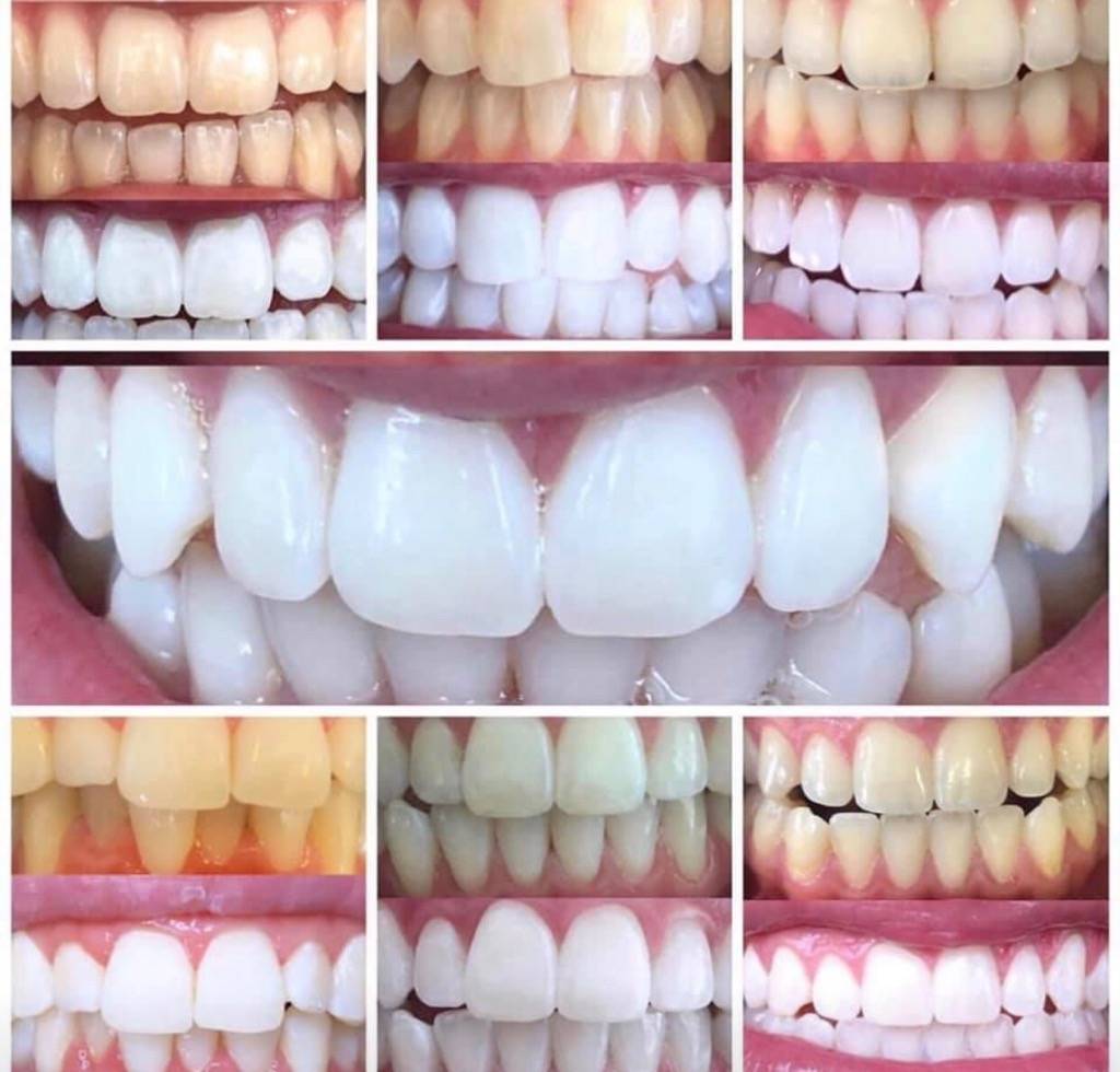 Bite Professional Teeth Whitening | 5780 Lincoln Dr UNIT 103, Minneapolis, MN 55436, USA | Phone: (612) 207-9662