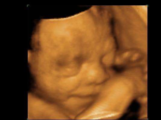 Belly 2 Birth 3D 4D Ultrasound | 209 Main St, Woodbridge Township, NJ 07095, USA | Phone: (908) 655-2939