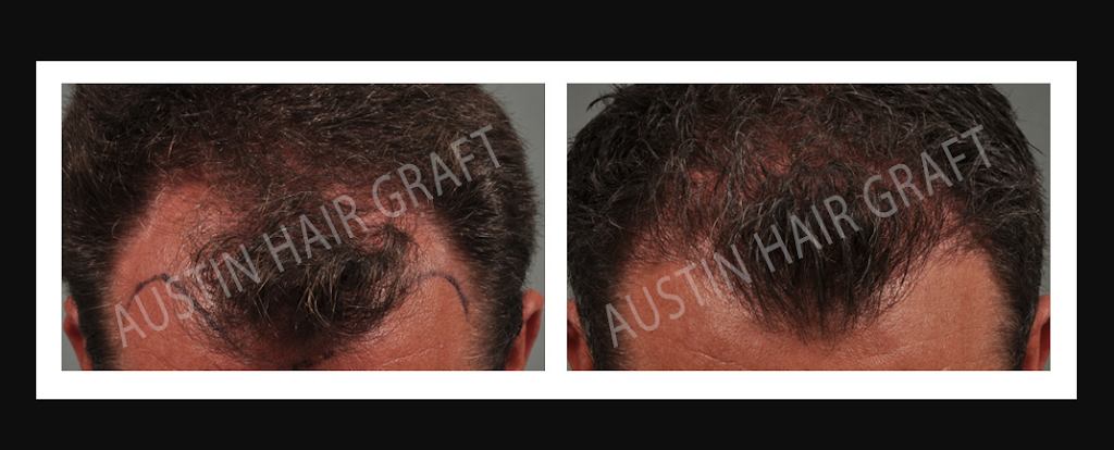 Austin Hair Graft | 300 Beardsley Ln #102, Austin, TX 78746, USA | Phone: (512) 327-5337