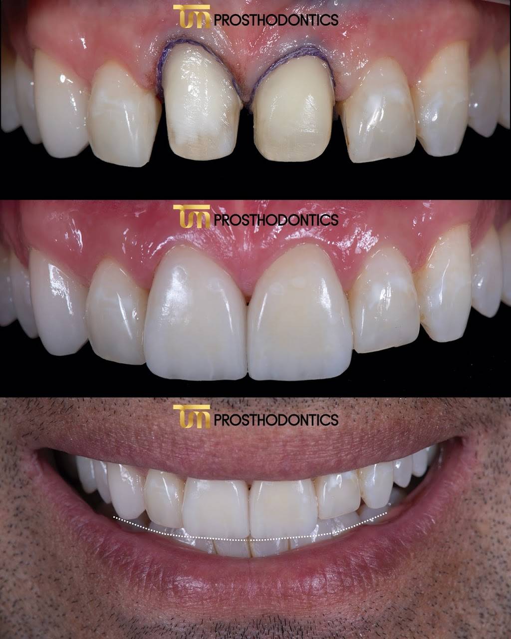 TM Prosthodontics - Dr. Tal Morr | 20760 W Dixie Hwy, Miami, FL 33180, USA | Phone: (305) 935-6066