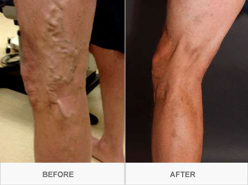 Fox Valley Vein Centers | 831 Sandhurst Dr, Sandwich, IL 60548, USA | Phone: (815) 786-3222