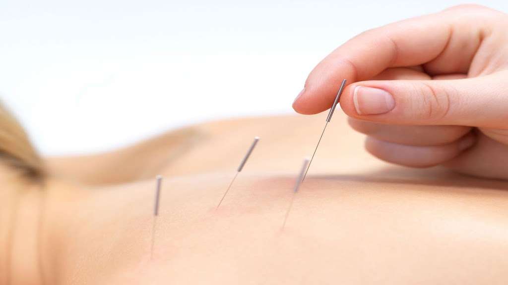 Physician Acupuncture | 452 Congress Ave #200, Havre De Grace, MD 21078, USA | Phone: (410) 939-0029