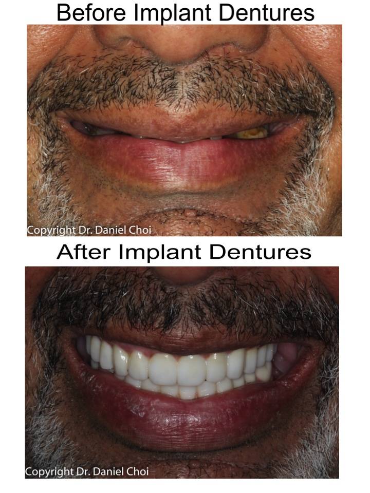 North Texas Dental Surgery Wisdom Teeth and Denture Implant Cent | 5345 W University Dr #100, McKinney, TX 75071, USA | Phone: (214) 592-0692