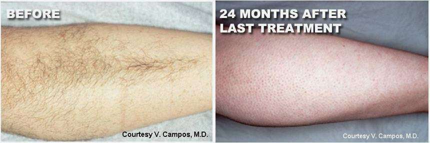 Style MedSpa/Laser Hair Removal Center of Montgomeryville | 120 Bethlehem Pike, Colmar, PA 18915, USA | Phone: (610) 572-3553