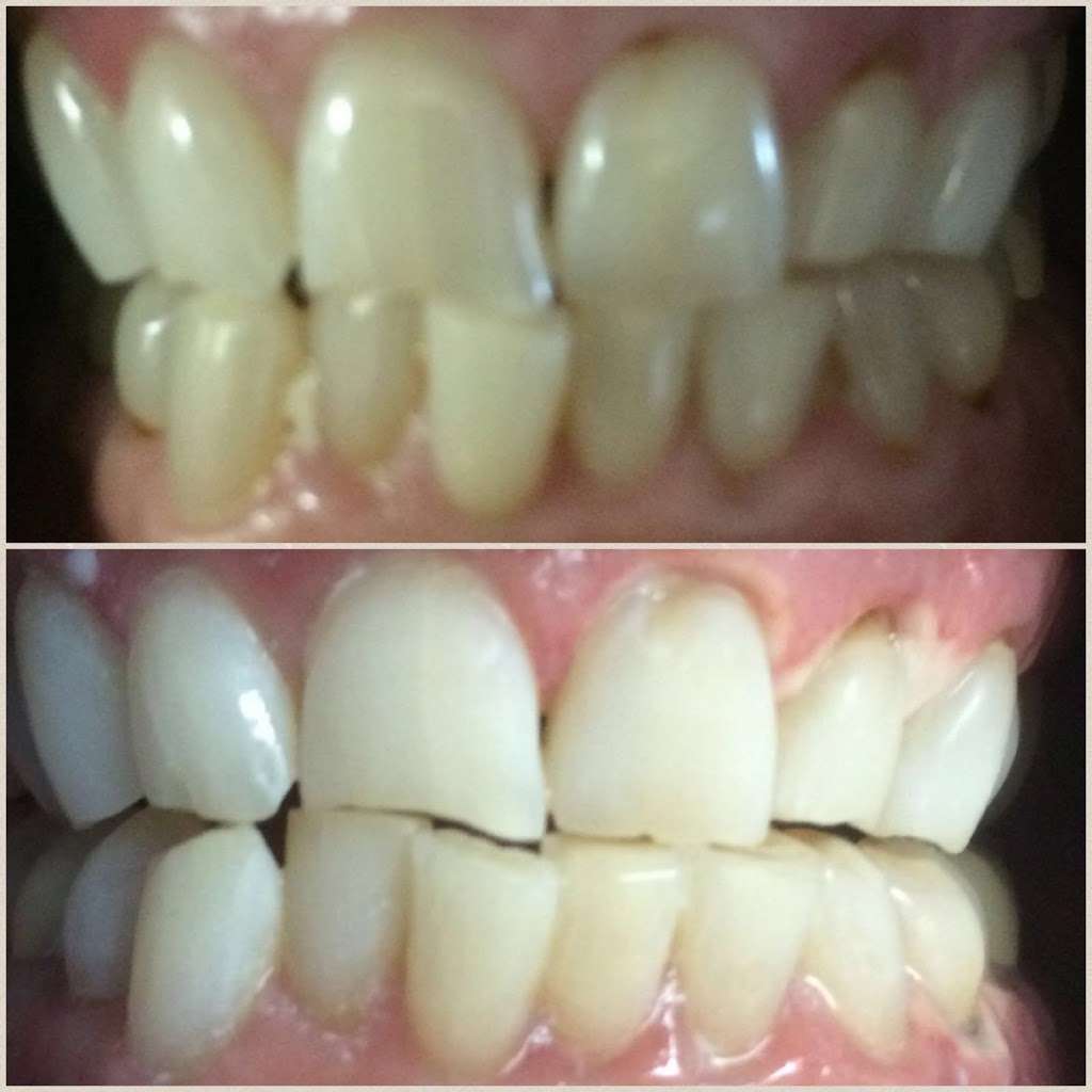 Yevonne’s laser teeth whitening LLC | 4933 S Carson St APT 212, Aurora, CO 80015 | Phone: (720) 629-9030