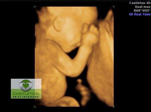 Castleton HD Ultrasound LLC | 7035 E 96th St Ste G, Indianapolis, IN 46250 | Phone: (317) 578-0442