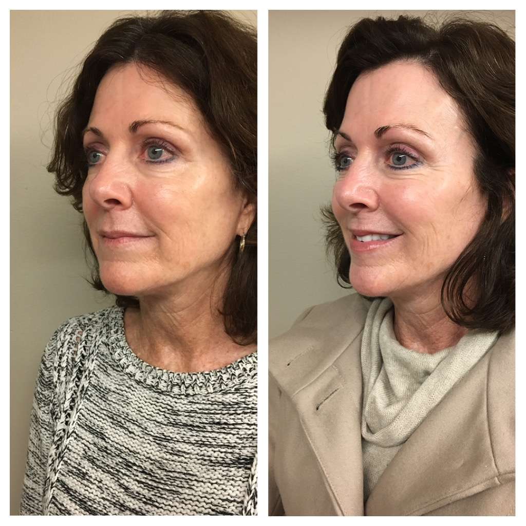 Dr. Happe Medical Aesthetics, LLC | 15 Homestead St, Waban, MA 02468, USA | Phone: (617) 597-2600 Dr. Happe Medical Aesthetics, LLC | 15 Homestead St, Waban, MA 02468, USA | Phone: (617) 597-2600