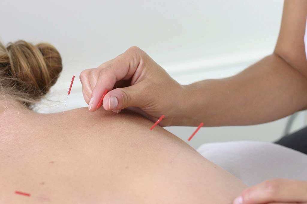 Bucks County Acupuncture Clinic | 9 Village Row, New Hope, PA 18938 | Phone: (267) 714-4149