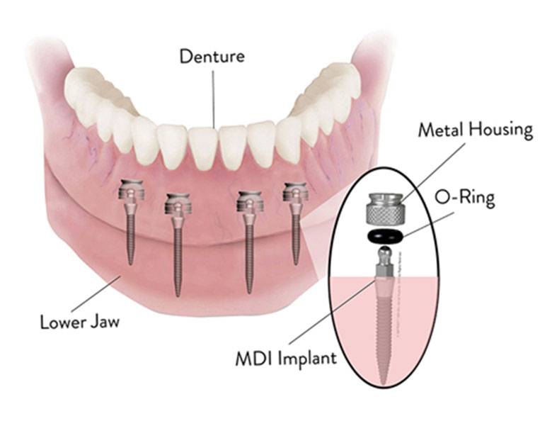 Mini Dental Implant Solutions Parma Heights, OH | 6285 Pearl Rd #11a, Parma Heights, OH 44130 | Phone: (440) 399-7599