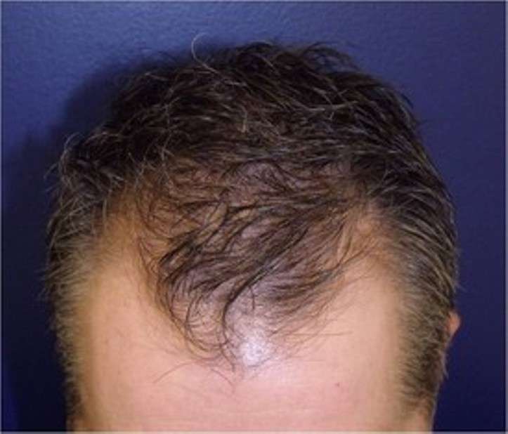 Chesapeake Hair Restoration - Hair Transplants in Baltimore, Mar | 10807 Falls Rd #101, Lutherville-Timonium, MD 21093, USA | Phone: (410) 753-8600