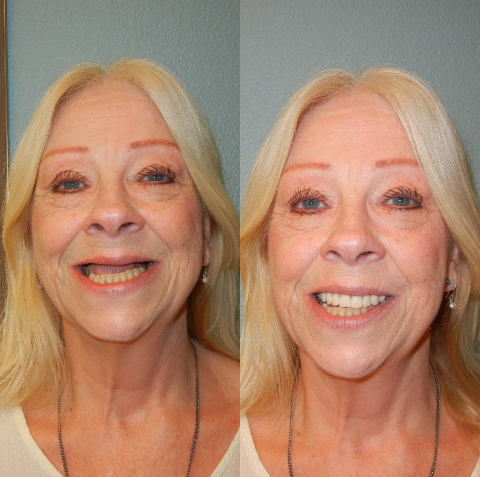 Evergreen Denture Center | 13720 NE 28th St SUITE B, Vancouver, WA 98682, USA | Phone: (360) 207-0621