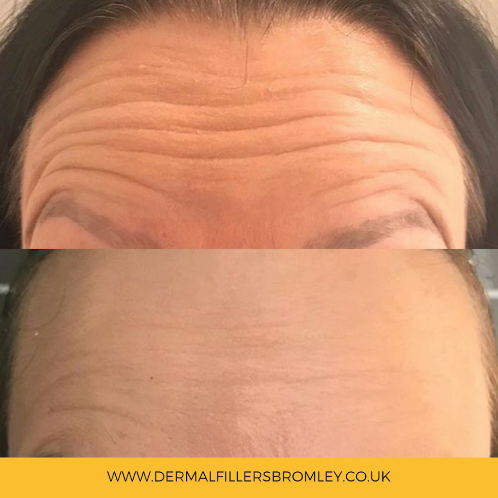 Dermal Fillers Bromley | Westbury Rd, Bromley BR1 2QB, UK | Phone: 07740 088563