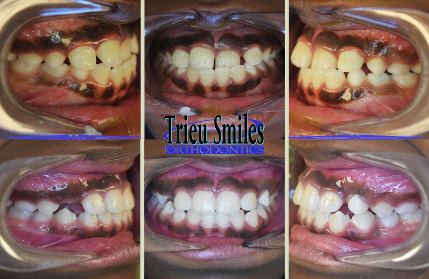 Trieu Smiles Orthodontics | 3708 4th St #103, Harvey, LA 70058 | Phone: (504) 309-7830