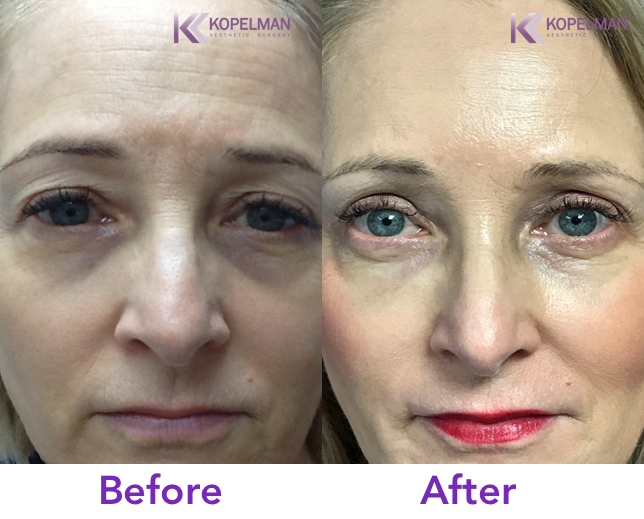 Kopelman Aesthetic Surgery | 1112 Park Ave suite 1a, New York, NY 10128 | Phone: (212) 831-8333