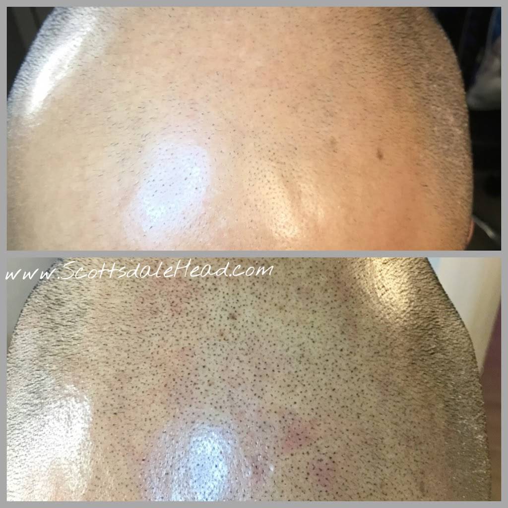 Scottsdale Hairlines Scalp MicroPigmentation Hairloss Clinic | 3295 N Drinkwater Blvd Suite 16, Scottsdale, AZ 85251, USA | Phone: (602) 680-0008