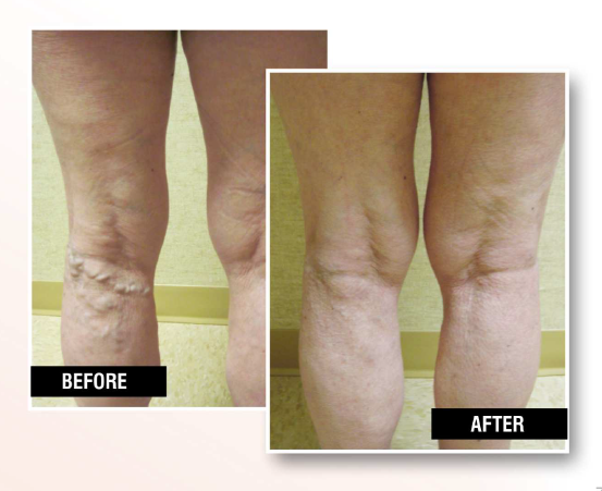 USA Vein Clinics | 1208B VFW Pkwy #300, West Roxbury, MA 02132 | Phone: (617) 391-6900