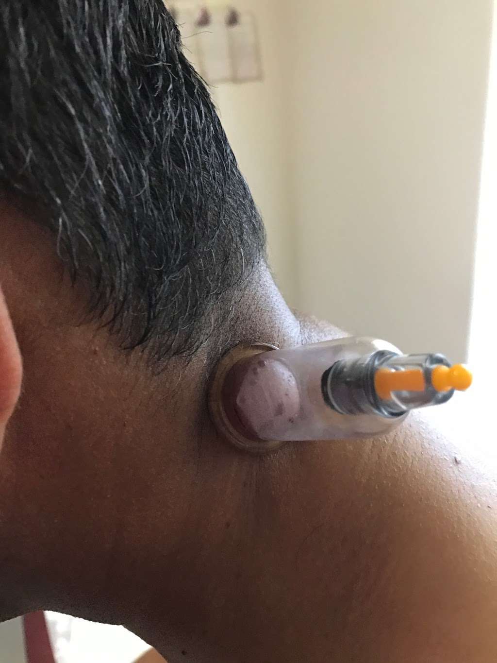 SHAAFI HIJAMA CUPPING CENTER | 4213 Birch Colony Ct, Porter, TX 77365, USA | Phone: (281) 508-4249