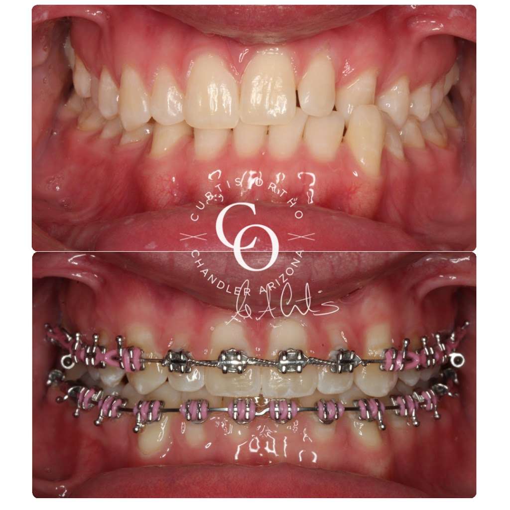 CURTIS ORTHODONTICS | 2963 W Elliot Rd #1, Chandler, AZ 85224, USA | Phone: (480) 838-7410