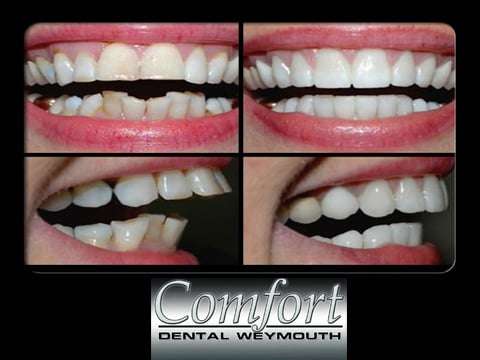 Comfort Dental Weymouth | 47 Washington St, Weymouth, MA 02188, USA | Phone: (781) 337-3300