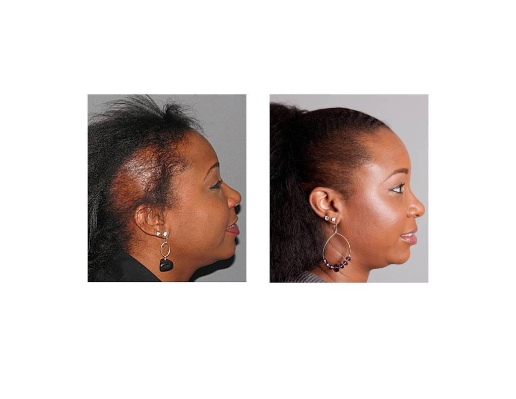 Bosley - Hair Restoration & Transplant | 2301 N Parham Rd #1, Richmond, VA 23229, USA | Phone: (804) 238-7358