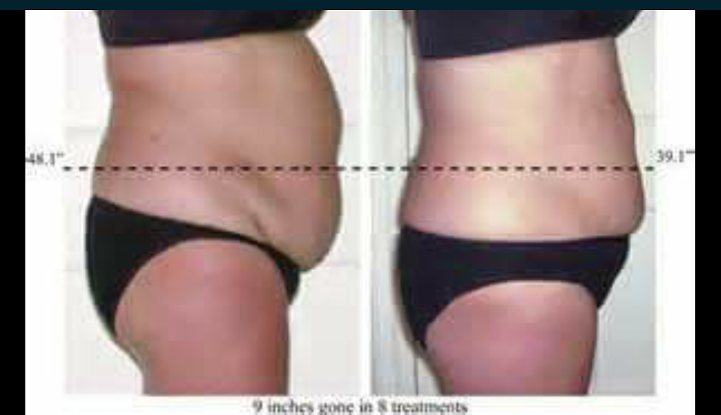 MARLTON LASER LIKE LIPO | 951 Tuckerton Rd A, Marlton, NJ 08053, USA | Phone: (856) 882-9532