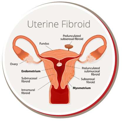 USA Fibroid Centers | 4141 Dundee Rd, Northbrook, IL 60062 | Phone: (847) 580-1312