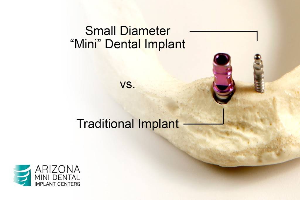 Arizona Mini Dental Implant Center | 944 N Gilbert Rd, Mesa, AZ 85203, USA | Phone: (480) 898-3053