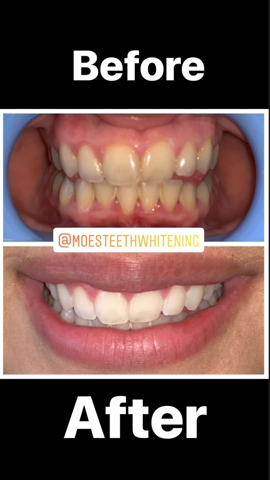 Moes Teeth Whitening | 1530 Jamacha Rd. #X, El Cajon, CA 92019, USA | Phone: (619) 922-1280