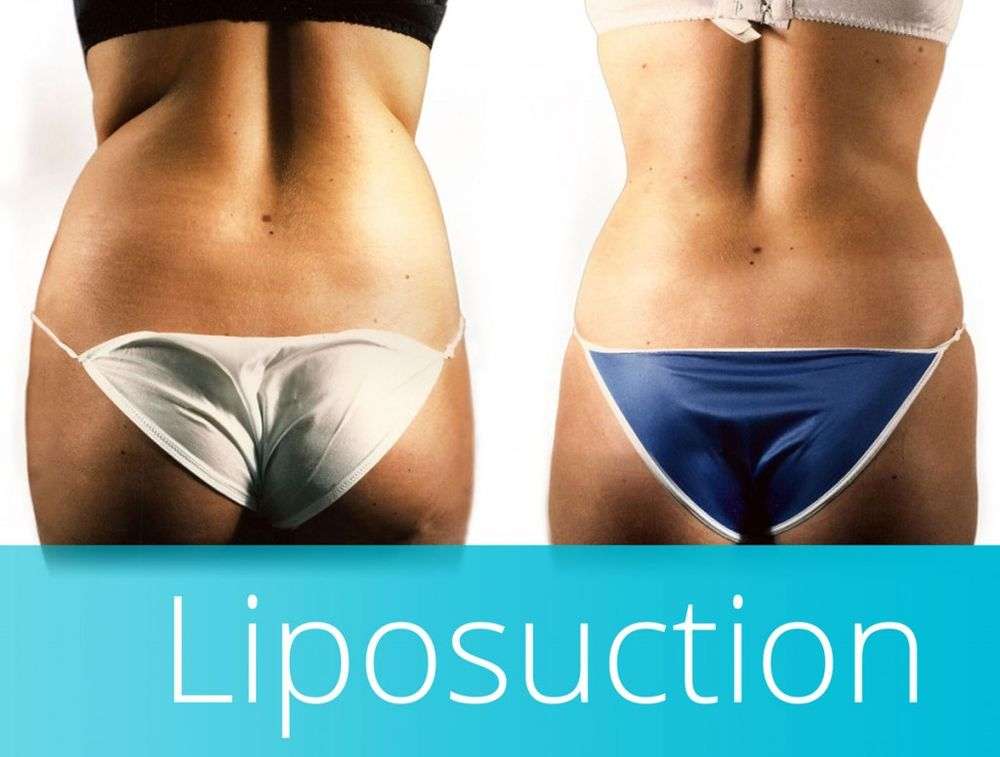 Smart Liposuction Houston | Houstons SmartLipo Experts | 6363 Woodway Dr Suite A-850, Houston, TX 77057, USA | Phone: (832) 429-2171