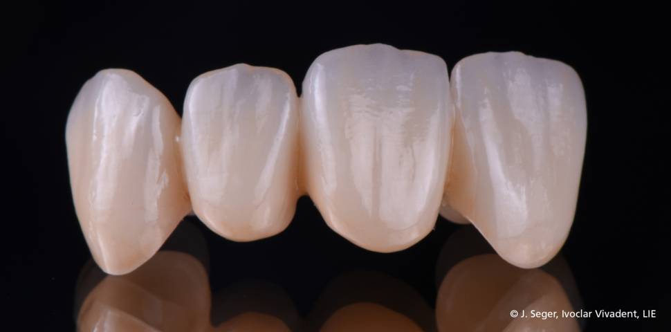 ZirCad Prime / 3M™ Lava™ Esthetic Fluorescent Full-Contour "Zirconia Crowns" | smiledesignerlab@outlook.com HT Dental Studio 6085, Water St #2405, Plano, TX 75024, USA | Phone: (214) 288-1509