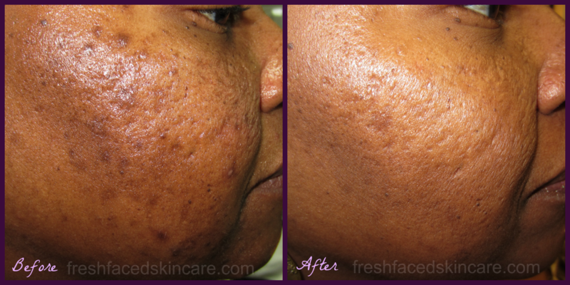 Fresh Faced Skin Care | 328 Kennett Pike #102, Chadds Ford, PA 19317, USA | Phone: (302) 689-3223