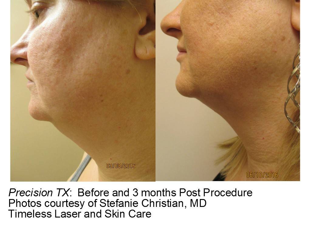 Timeless Laser & Skin Care | 29160 Center Ridge Rd, Westlake, OH 44145, USA | Phone: (440) 779-1000