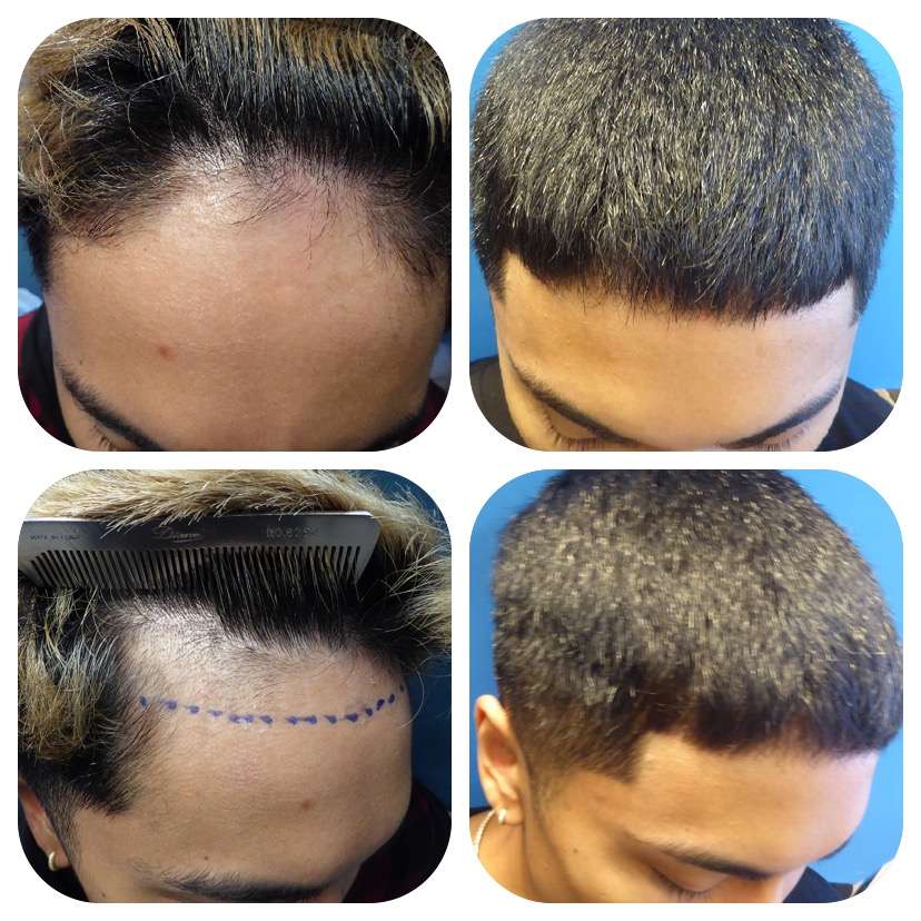 Meshkin Medical - Cosmetic Hair Restoration and Hair Transplant  | 912 W Glenoaks Blvd, Glendale, CA 91202, USA | Phone: (800) 246-8424