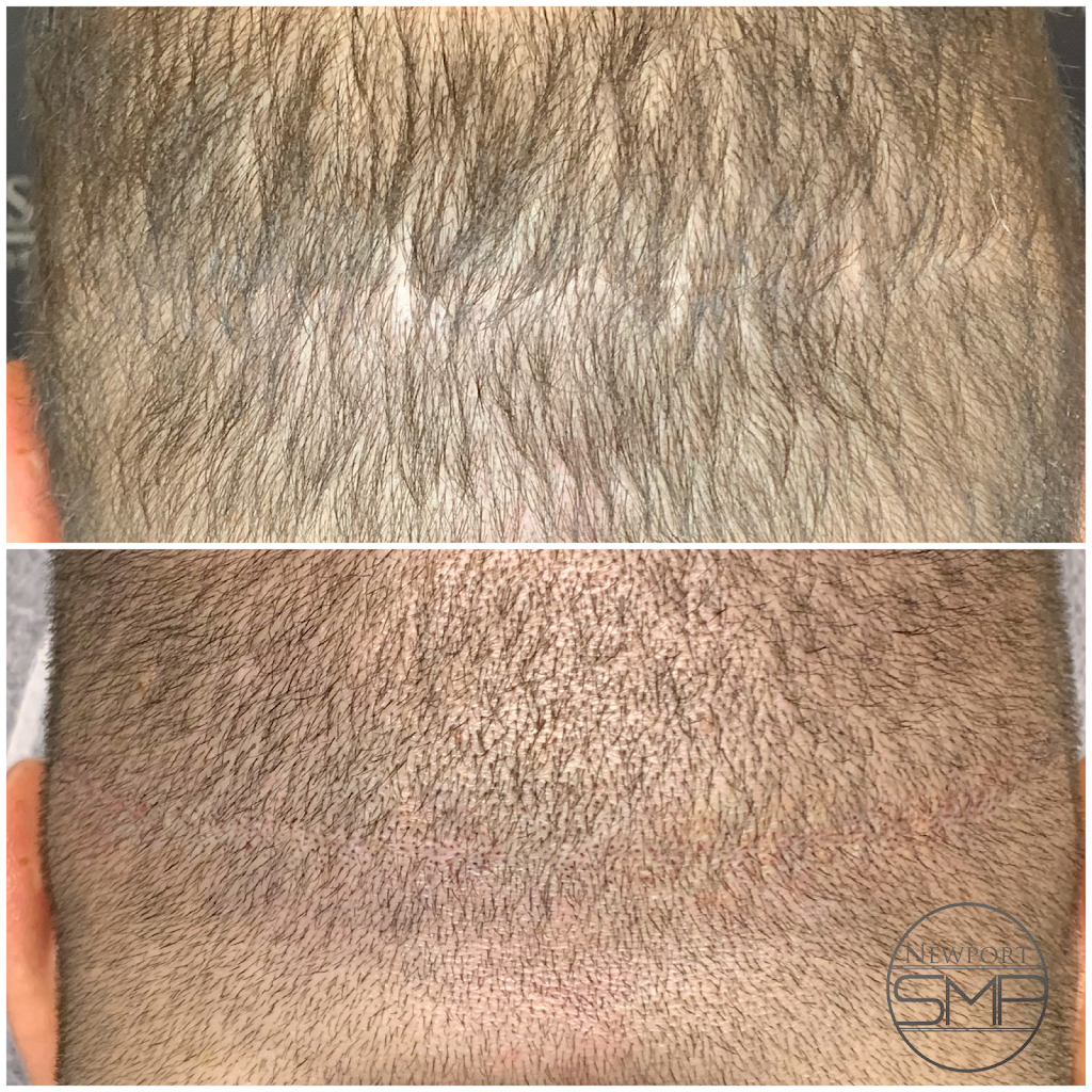 Newport Beach SMP Hair Restoration | 4120 Birch St #102, Newport Beach, CA 92660, USA | Phone: (949) 520-2525