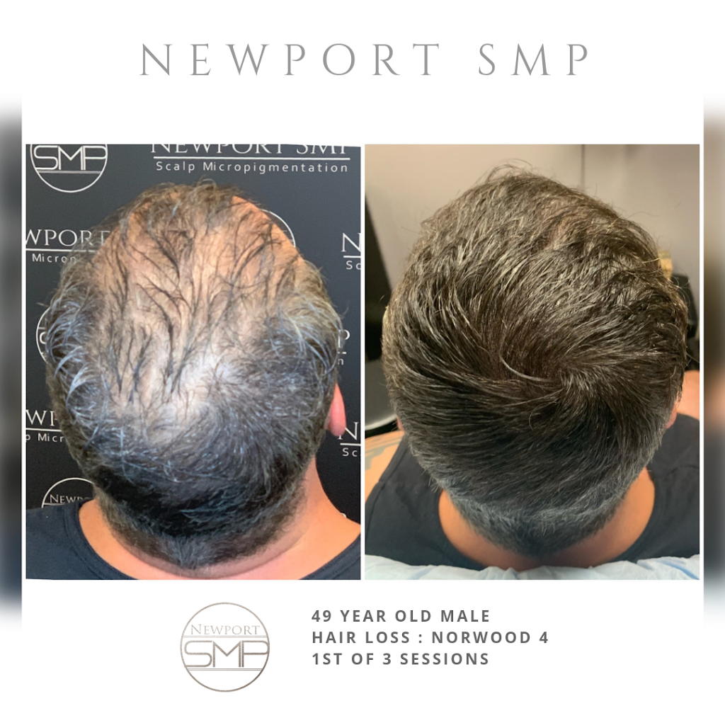 Newport Beach SMP Hair Restoration | 4120 Birch St #102, Newport Beach, CA 92660, USA | Phone: (949) 520-2525