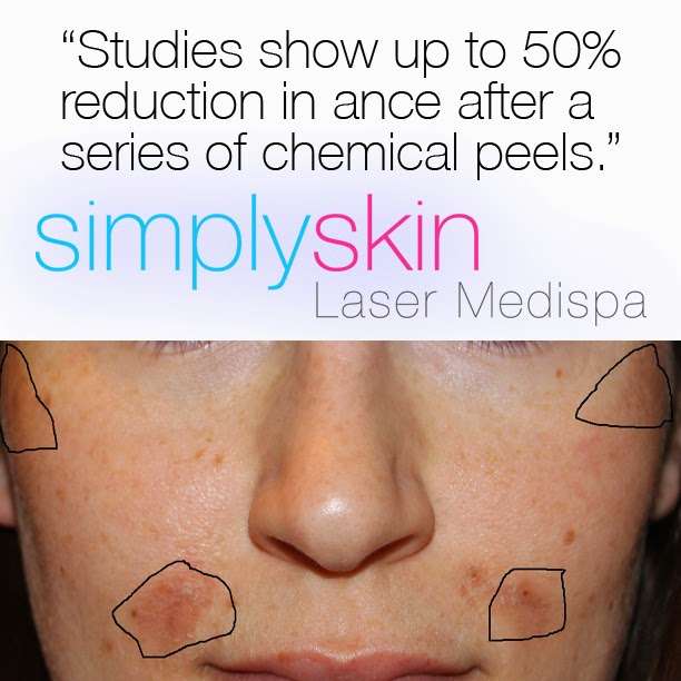 Simply Skin Laser Medispa | 880 Mile Square Rd, Yonkers, NY 10704, USA | Phone: (914) 374-6914