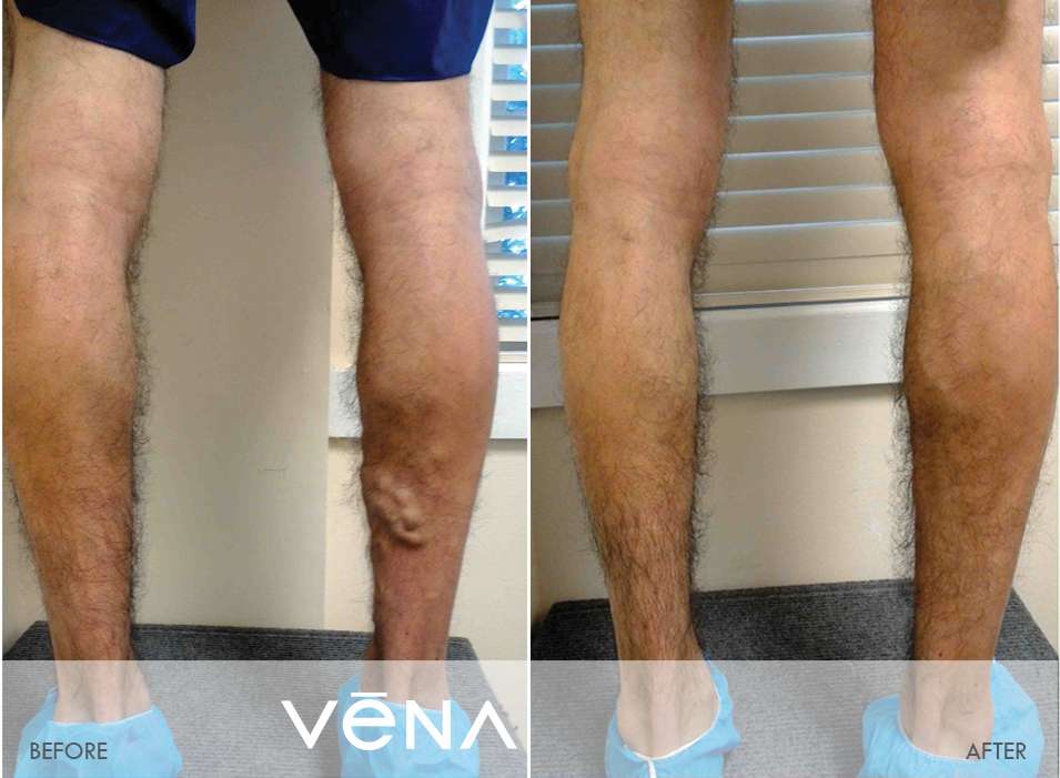 Vena Vascular Pasadena | 333 N Hill Ave, Pasadena, CA 91106, USA | Phone: (626) 449-9922