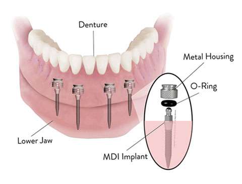 Dental Implant Solutions Oswego, IL | 1301 Orchard Rd #1, Oswego, IL 60543, USA | Phone: (630) 449-3734