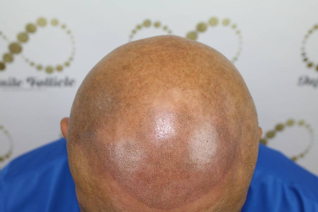 Infinite Follicle Scalp MicroPigmentation LLC. | 2200 E River Rd #125, Tucson, AZ 85718, USA | Phone: (520) 809-2188