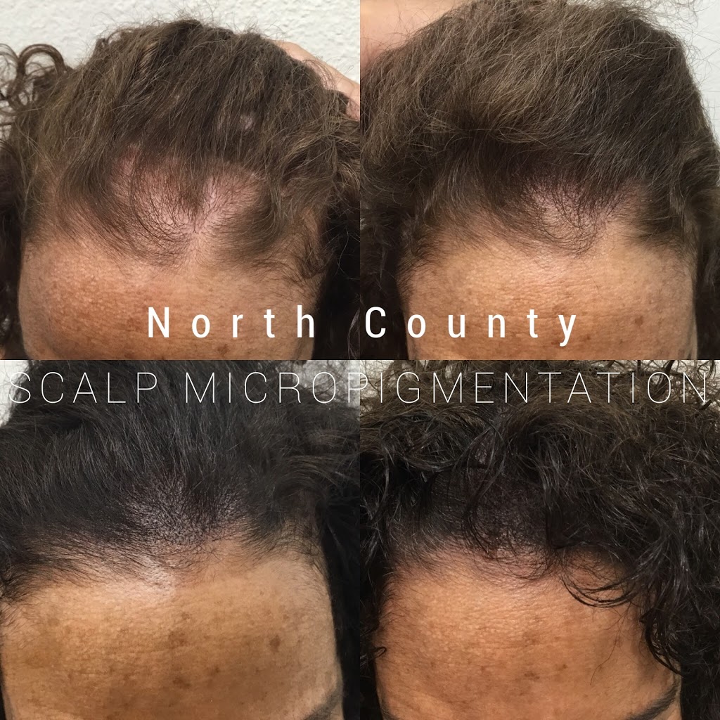 North County Scalp Micropigmentation | 1172, 1822 Marron Rd, Carlsbad, CA 92008, USA | Phone: (760) 805-6801