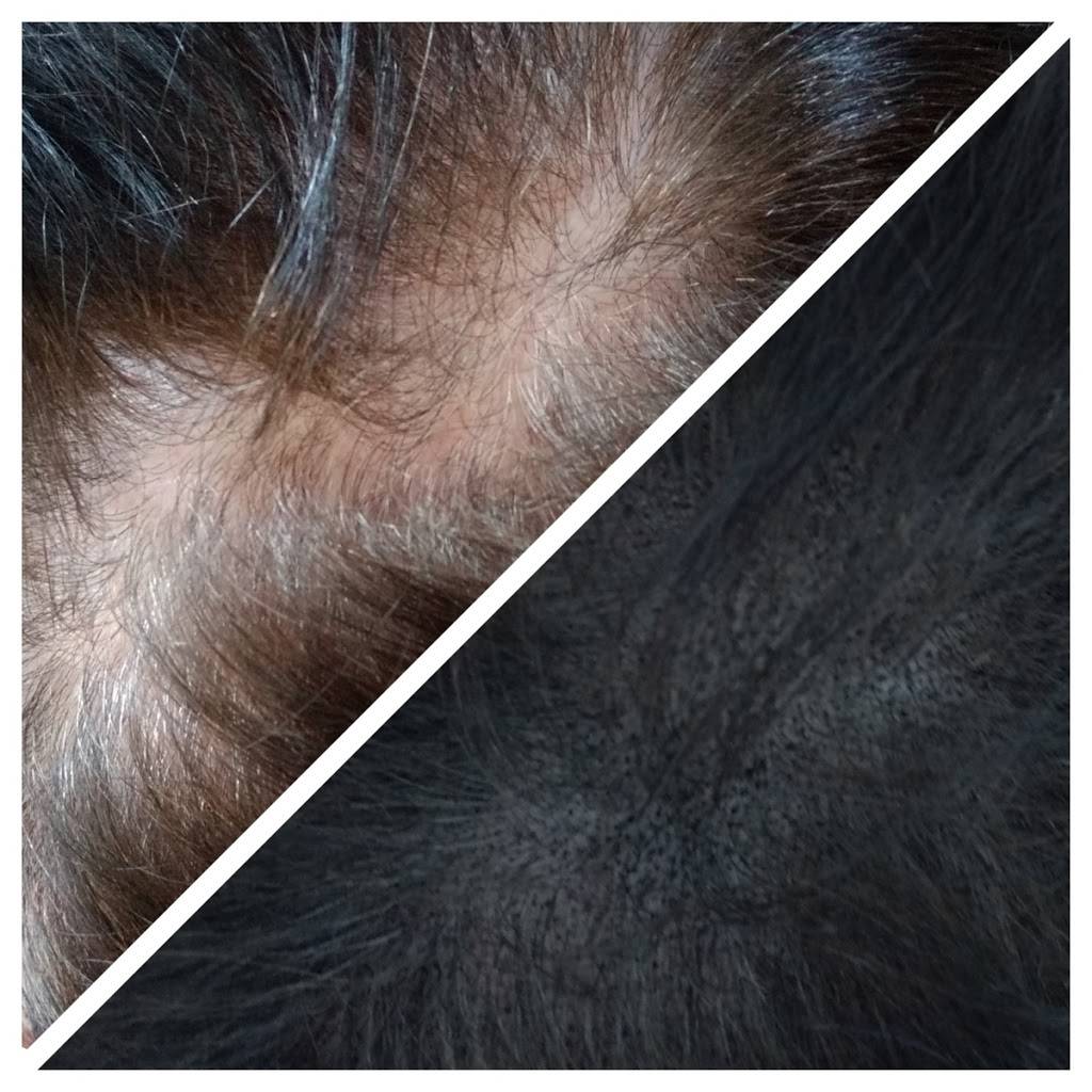 Impressions Scalp Micropigmentation | 1140 Youngs Rd, Buffalo, NY 14221, USA | Phone: (716) 465-9955