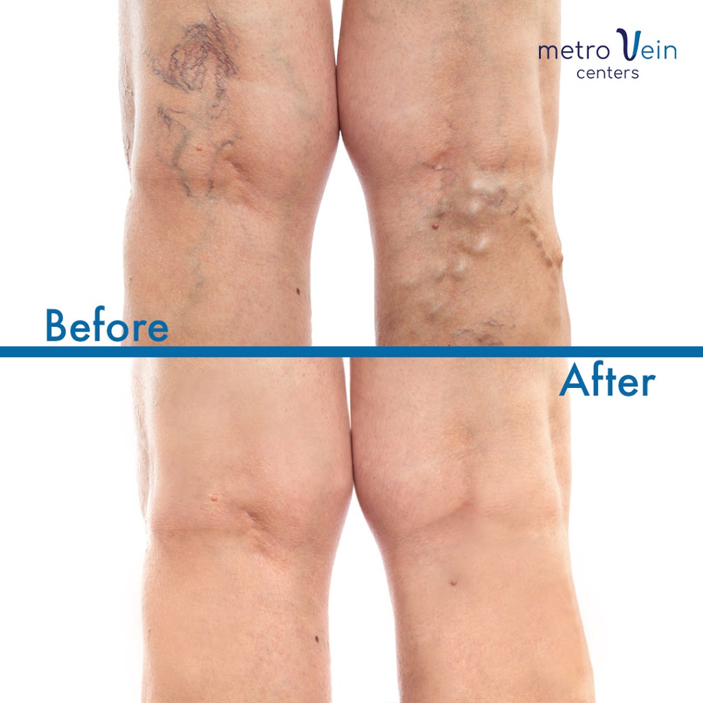 Metro Vein Centers | 385 Prospect Ave Suite 316, Hackensack, NJ 07601, USA | Phone: (201) 581-0773