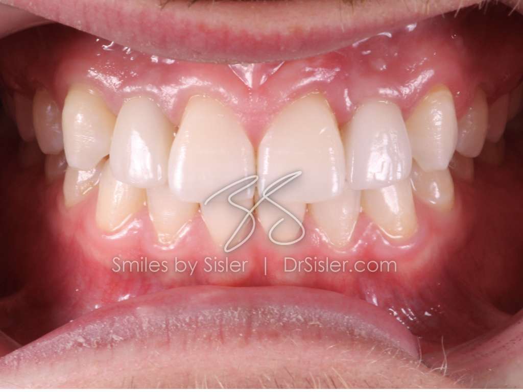 Smile Design by Sisler | 1020 Orrstown Rd, Shippensburg, PA 17257 | Phone: (717) 532-8740