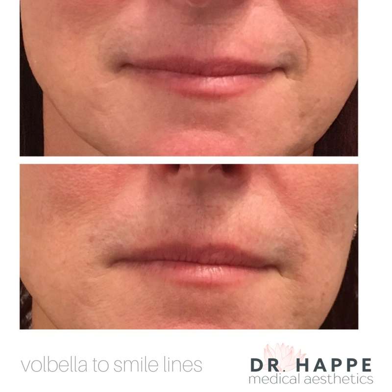 Dr. Happe Medical Aesthetics, LLC | 15 Homestead St, Waban, MA 02468, USA | Phone: (617) 597-2600 Dr. Happe Medical Aesthetics, LLC | 15 Homestead St, Waban, MA 02468, USA | Phone: (617) 597-2600