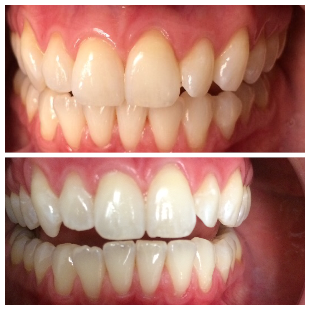 Lumin Teeth Whitening | 12841 Jones Rd #208, Houston, TX 77070 | Phone: (281) 463-4601