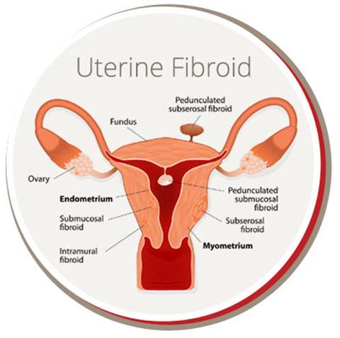 USA Fibroid Centers | 384 E 149th St #201, The Bronx, NY 10455, United States | Phone: (347) 580-5015