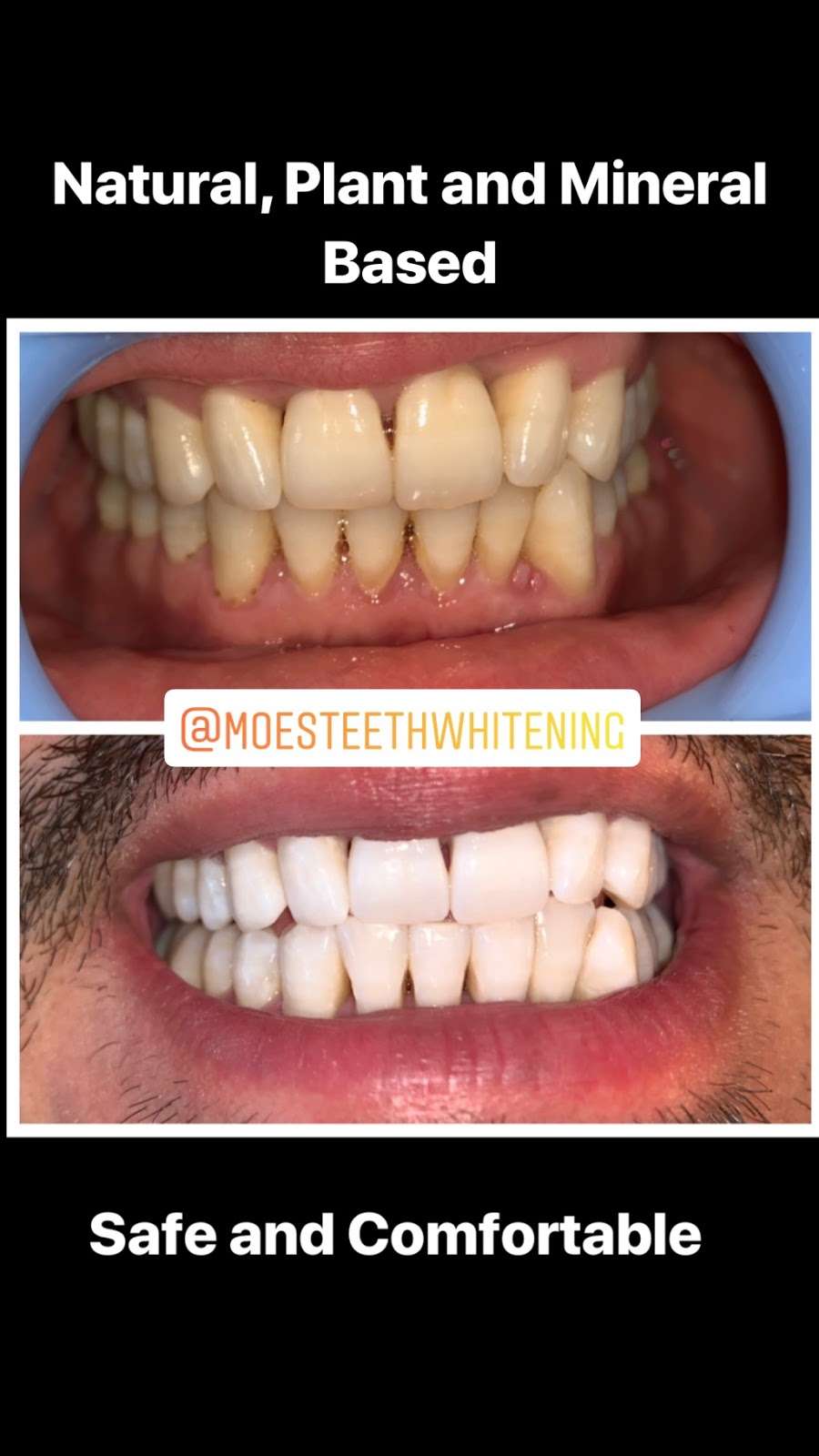 Moes Teeth Whitening | 1530 Jamacha Rd. #X, El Cajon, CA 92019, USA | Phone: (619) 922-1280