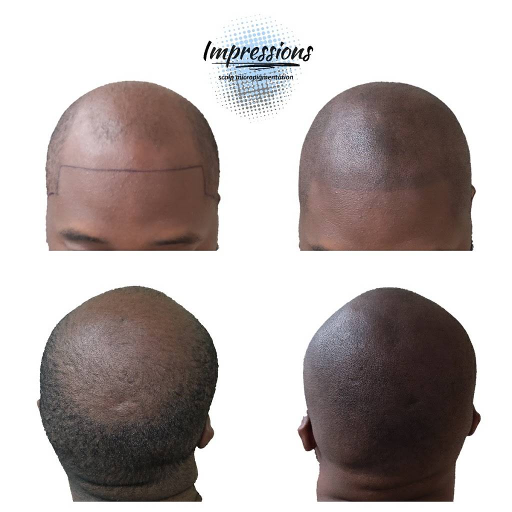 Impressions Scalp Micropigmentation | 1140 Youngs Rd, Buffalo, NY 14221, USA | Phone: (716) 465-9955