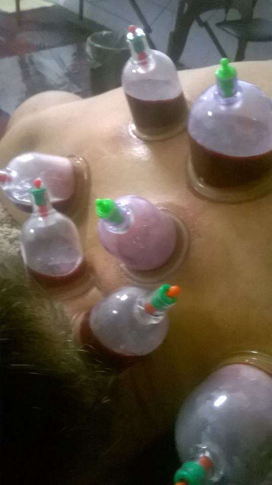 Remedify Cupping Therapy & Alternative Medicine | 13703 Coldfall Court, Richmond, TX 77407, USA | Phone: (713) 340-8496