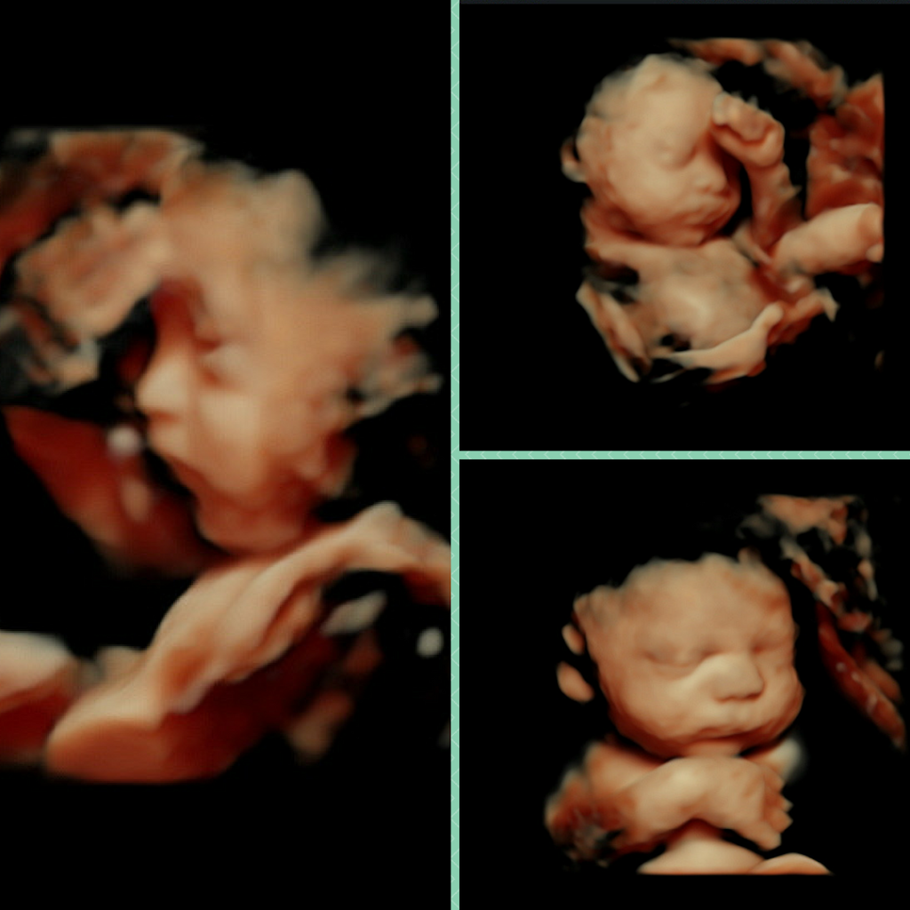 My First Foto 3D 4D Ultrasound | 10161 Bolsa Ave #205A, Westminster, CA 92683 | Phone: (714) 824-1313